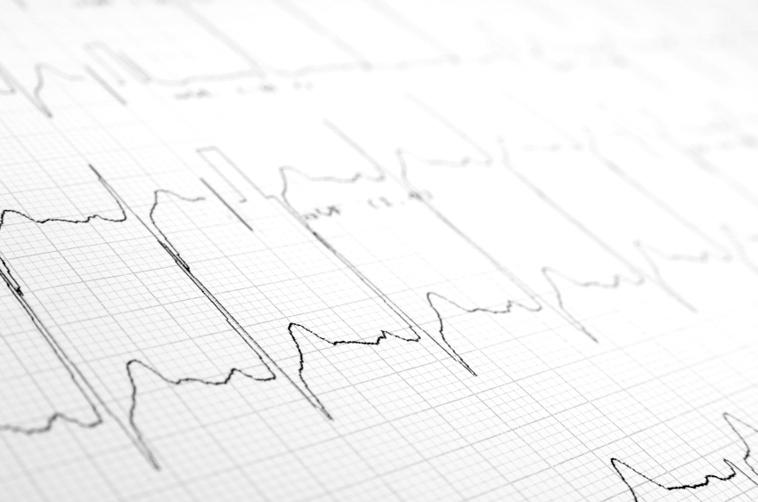 Electrocardiogram